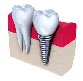 protesi di denti in metallo ceramica