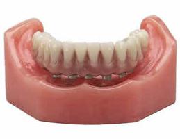 снимка на стоматологична протеза