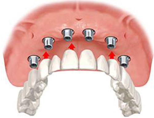 recensioni di protesi dentarie