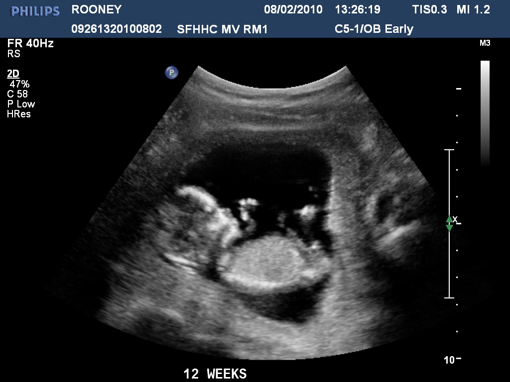 Ultrazvuk, kde je dítě viditelné