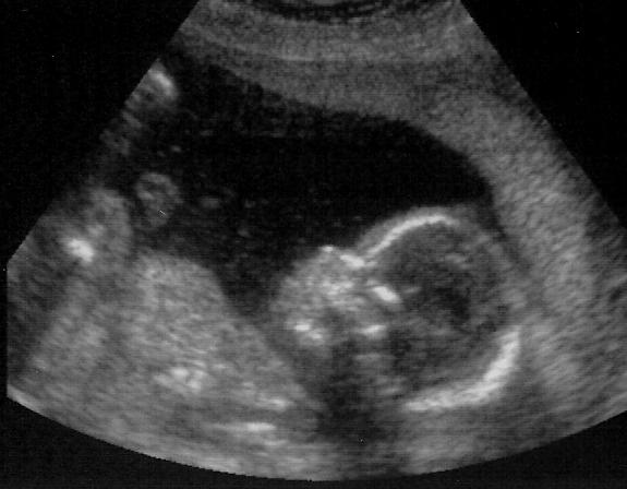 ultrazvuk u razdoblju od 20 tjedana