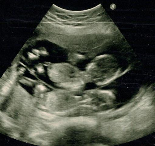 dvojčka na ultrazvoku 20 tednov