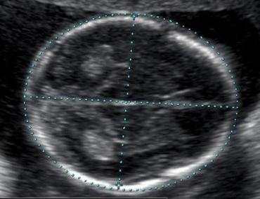 Ultrazvok možganov novorojenčka