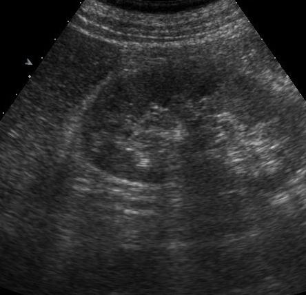 transkript ultrazvučnog bubrega