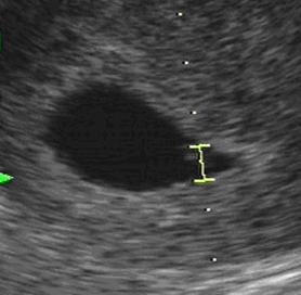 ultrazvuk dělohy