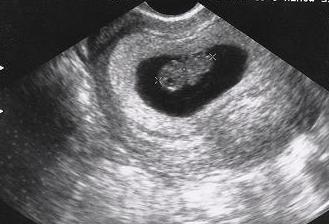 ecografia dell'utero e appendici