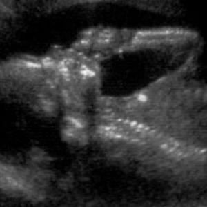 ultrazvuk uterusa