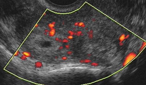 ecografia dell'utero durante la gravidanza