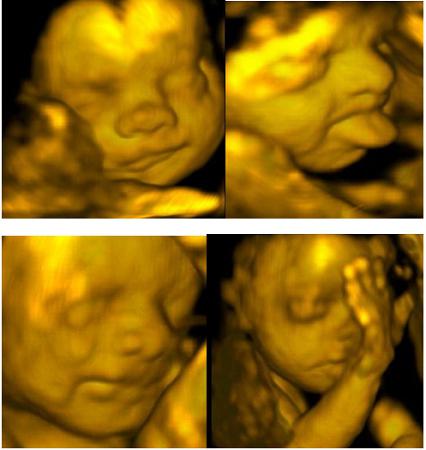 ultrazvuk dělohy a vaječníků