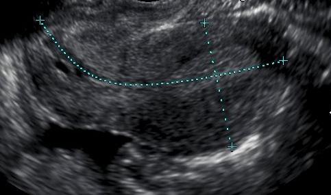 ecografia dell'utero dopo il parto