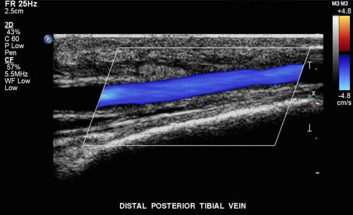 ultrazvok krvnih žil spodnjih okončin