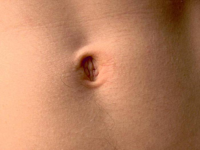 Umbilická kýla u žen