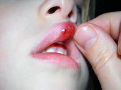 Otekla zgornja ustnica