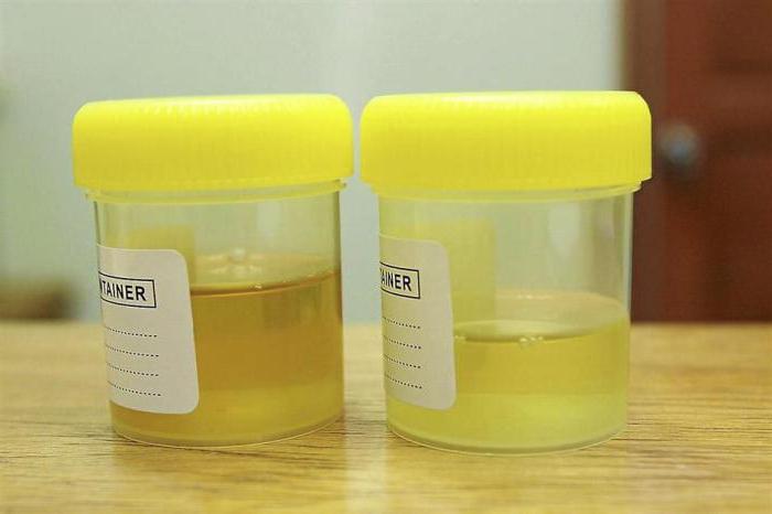 risultati dell'analisi delle urine di sulkovich