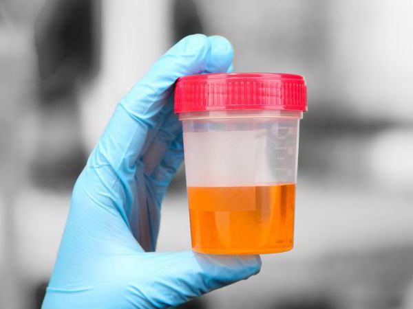 urobilinogena v urinu med nosečnostjo