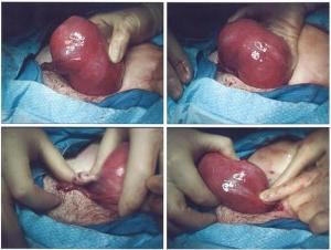 maternične fibroide in nosečnost