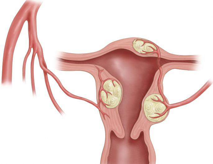 Embolizace děložních fibroidů