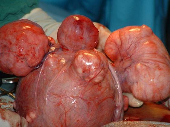 fibrom maternice