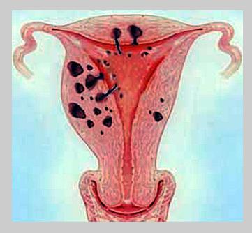 adenomiosi dell'utero 1 grado