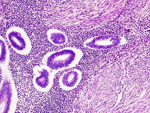 adenomyóza těla dělohy