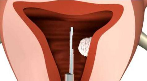 uklanjanje histeroskopije uterusa polipa