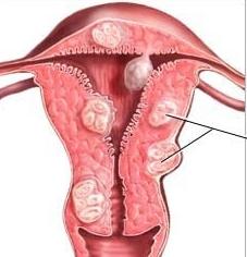 piccolo mioma uterino