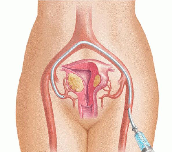 léčba fibroidů bez operace