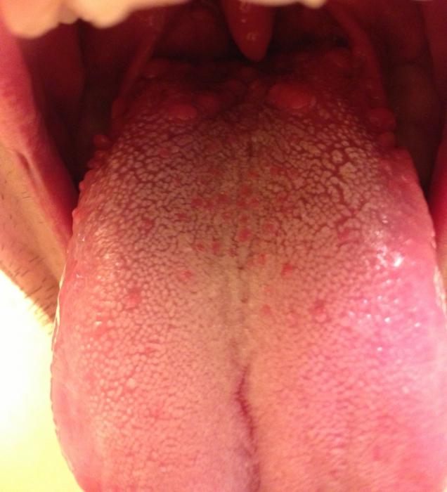 otekanje jezika v grlu