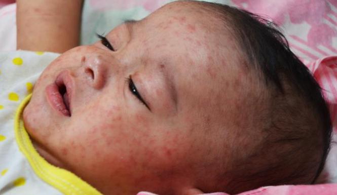 Cepljenje proti otroški paralizi: učinki