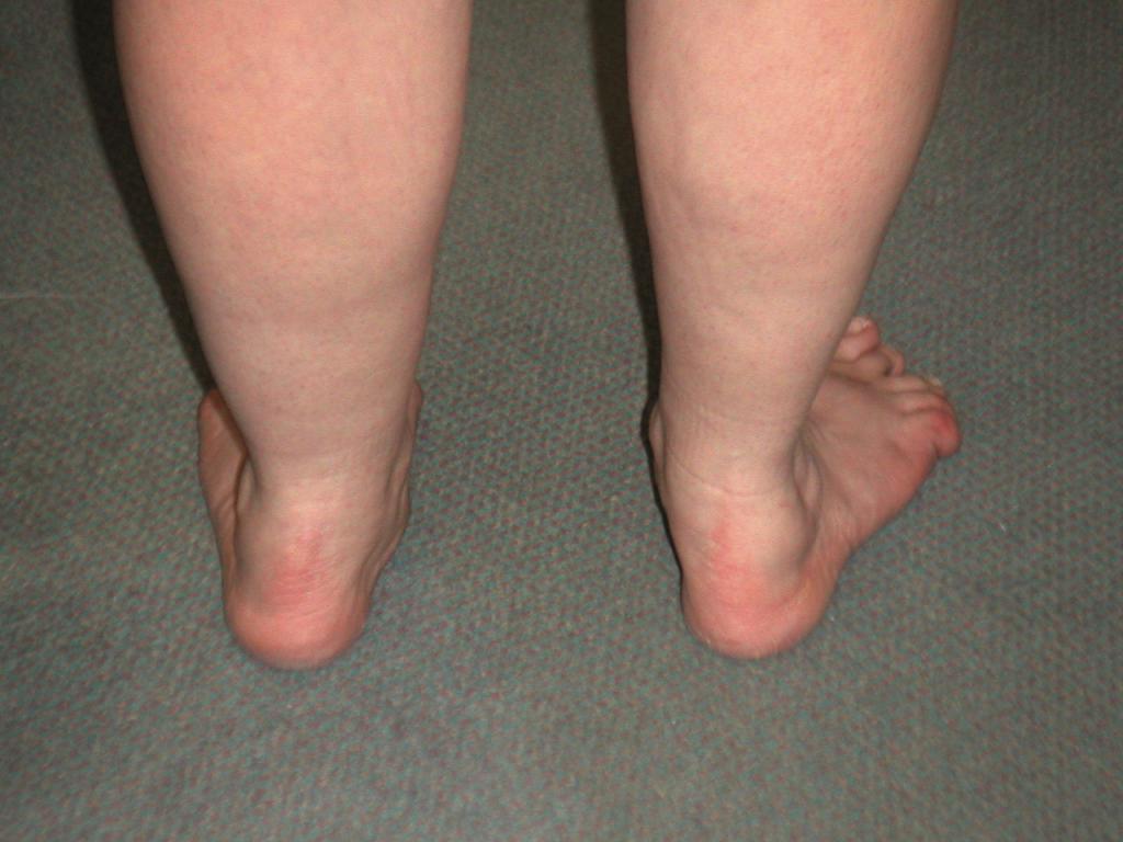 Deformacja stopy