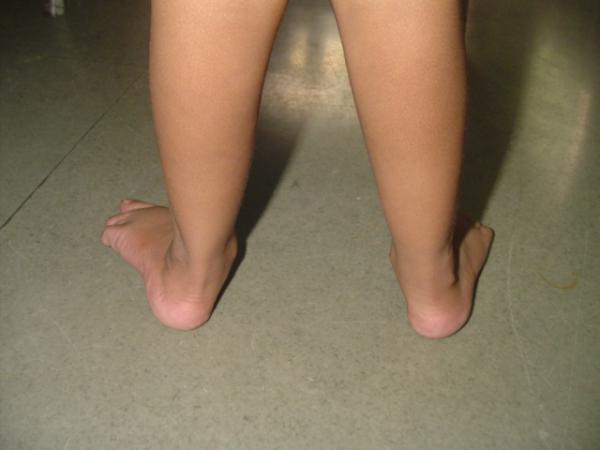 artroze mišljenja tretman stopala
