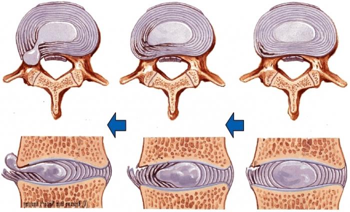 vertebrální kýla
