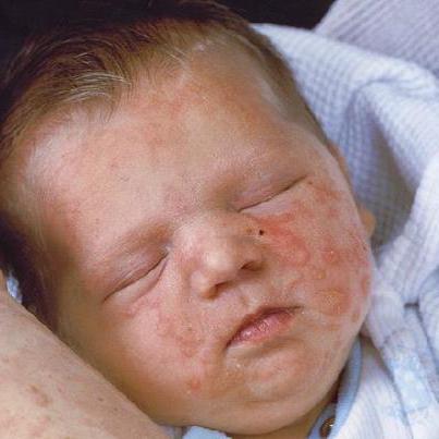Virus pemphigus u djece.  liječenje