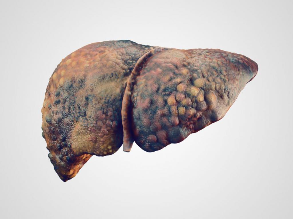 циротичен черен дроб