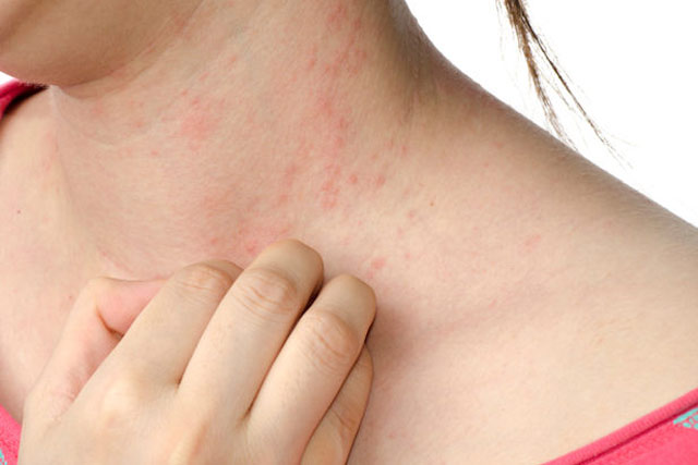 Reazione allergica sulla pelle