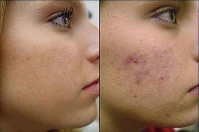 jak odstranit známky akné na obličeji