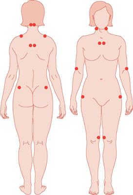 punti di dolore sul diagramma del corpo umano