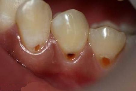 difetti dei denti a forma di cuneo