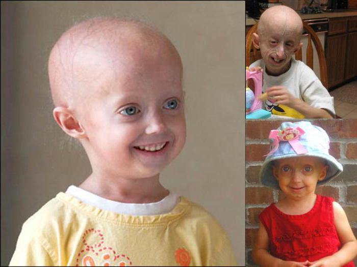 sindrome di progeria werner