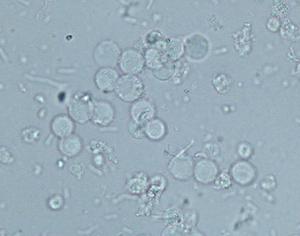 Какво представляват левкоцитите в урината