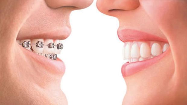 językowe aparaty ortodontyczne
