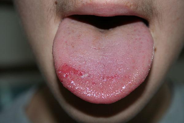 červené skvrny na jazyku