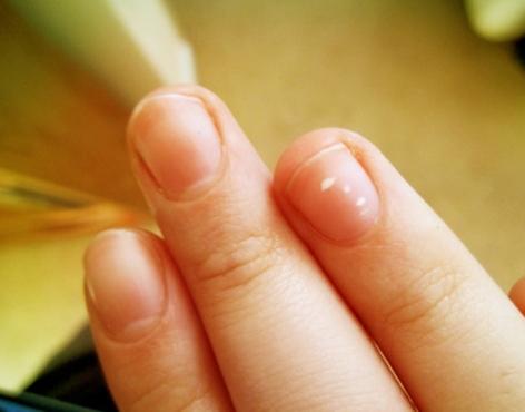 macchie bianche sulle unghie delle mani