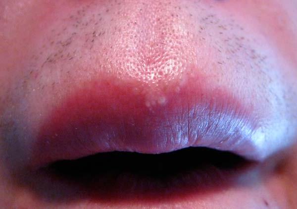 bele pike na ustnicah