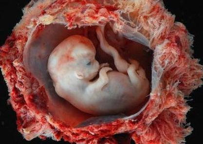 Как изглежда ранен аборт?
