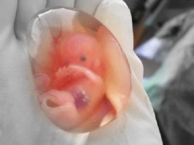 Как изглежда един спонтанен аборт?
