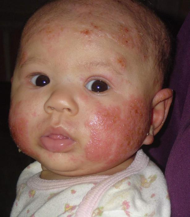 Alergie u kojenců