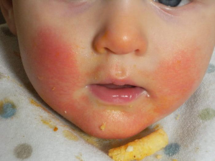Алергије на храну код деце