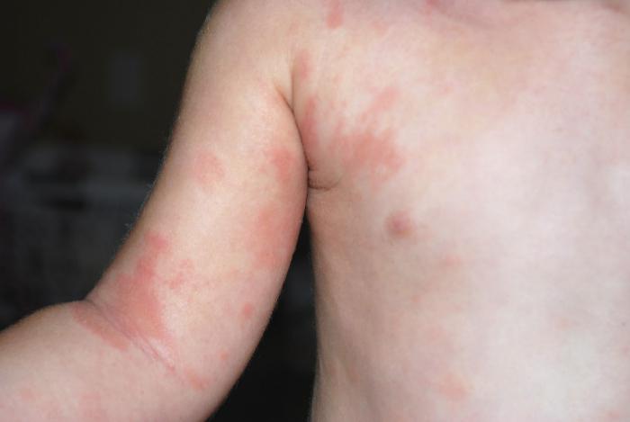 Kako alergija pri dojenčkih