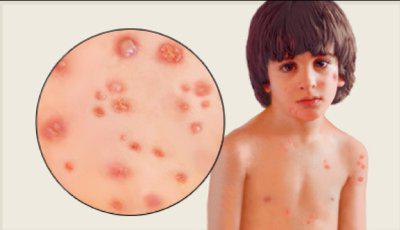 che cosa è l'acne con la varicella